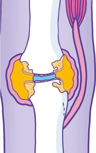 由类风湿关节炎影响的食指MCP关节的图形表示。