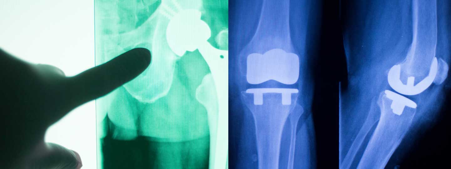 查看臀部和膝盖置换的X射线。