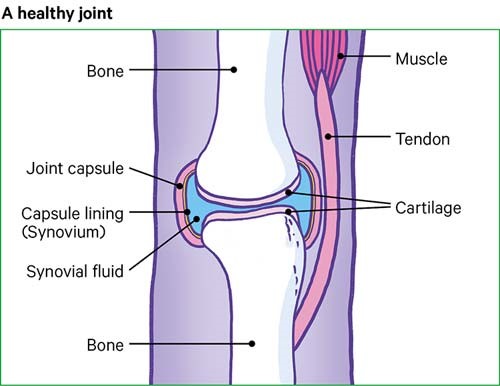 A healthy joint with no damage to the bone, cartilage or synovium.